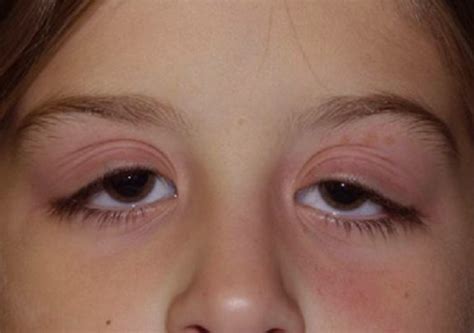 Swollen Eyelid - Symptoms, Treatment, Pictures, Causes | HealDove