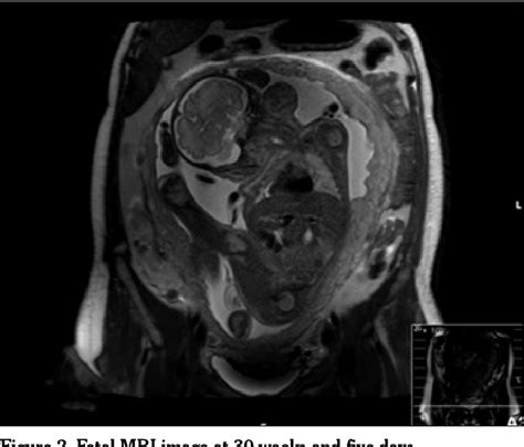 Figure From Prenatal Diagnosis And Management Of A Fetal Neck Mass