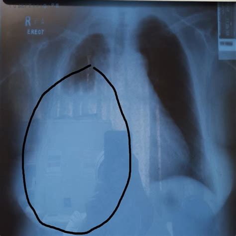 Chest X Ray Shows Right Pleural Effusion In Circle Line Download