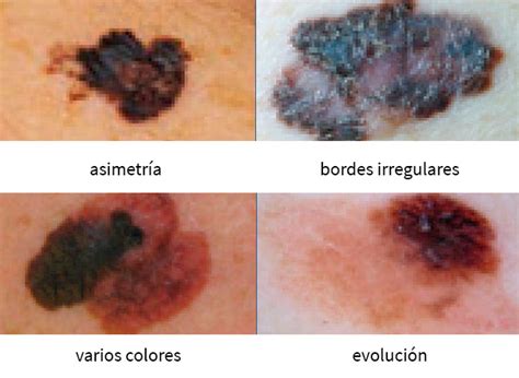 Manchas Y Melanoma Todo Lo Que Debes Saber Para Revisar Tu Piel