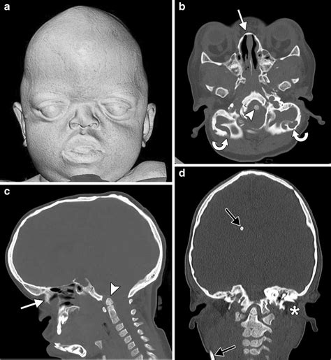 Craniofacial Syndrome In A 2 Year Old Girl With Crouzon Syndrome