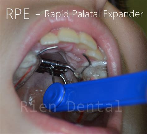 Rpe Rapid Palatal Expander