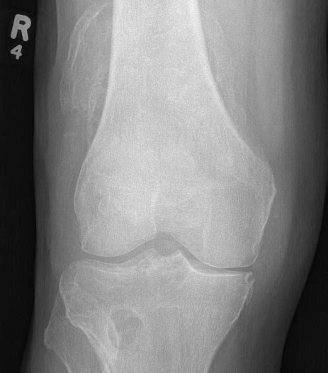 Synovial Chondromatosis | The Bone School