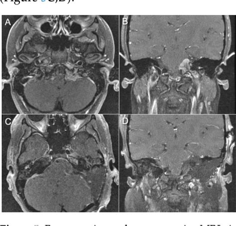 Figure 1 From Jugular Foramen Tumors Surgical Strategies And