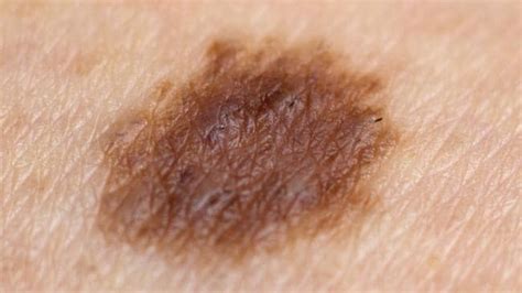 Skin cancer check: Number of moles on your right arm an indicator of ...