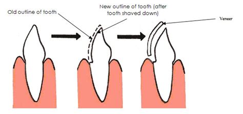 The Process Of Getting Veneers | Tooth Implant London