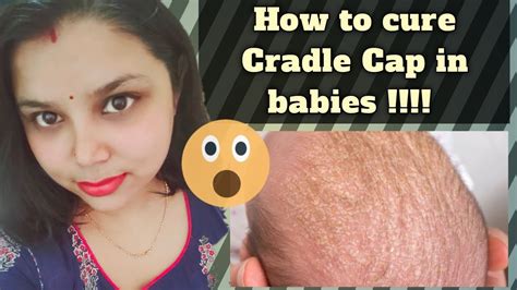 How To Cure The Problem Of Cradle Cap In Infants Momnation Youtube