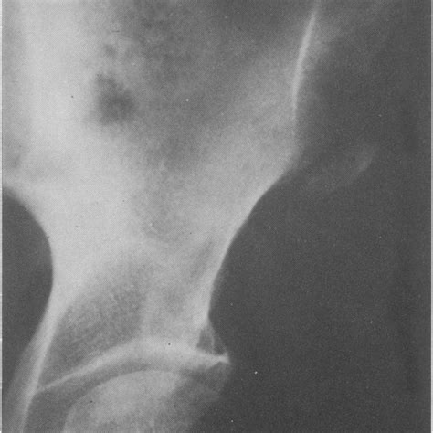 Radiograph Of Right Hip Showing An Avulsion Fracture Of The Anterior