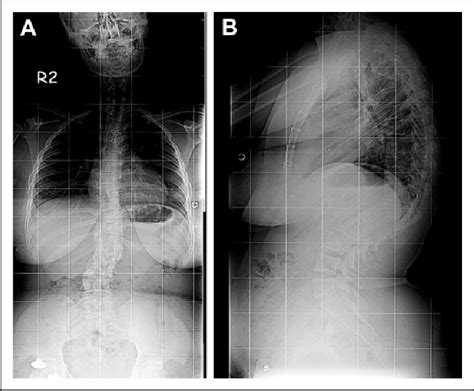 (A) Congenital kyphosis, preoperative PA X-ray. (B) Congenital ...