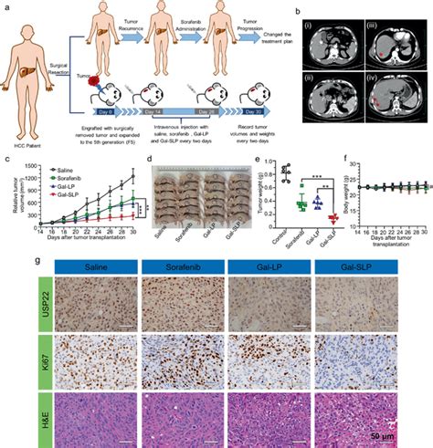 The Antitumor Activity Of Galslp In A Sorafenibinsensitive Hcc Pdx