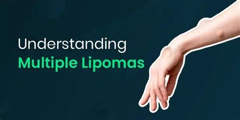 Understanding Multiple Lipomas Causes Diagnosis And Management