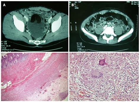 Appendicular Tuberculosis The Resurgence Of An Old Disease With