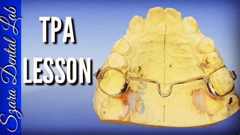 How To Make A Transpalatal Arch Tpa Orthodontic Appliance By Szara