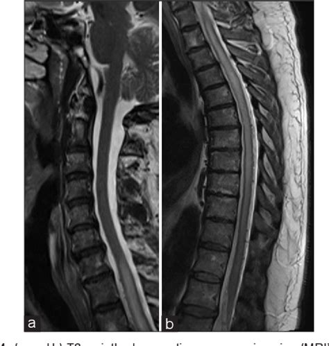 Figure 1 From Neurophysiological Monitoring In Spinal Dural