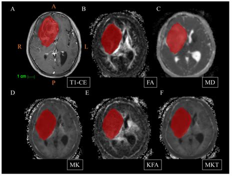 Figure 1 From Machine Learning Based On Diffusion Kurtosis Imaging Histogram Parameters For