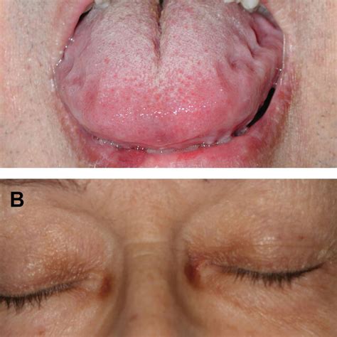 Amyloidosis A Macroglossia With Characteristic Crenations Along