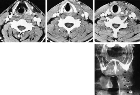 Neck Infection Associated With Pyriform Sinus Fistula Imaging Findings American Journal Of