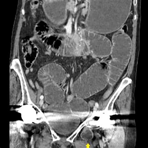 Axial Section Demonstrating Small Bowel Loops In Left Obturator Space