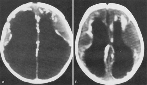 Cerebral Infections And Inflammation Radiology Key