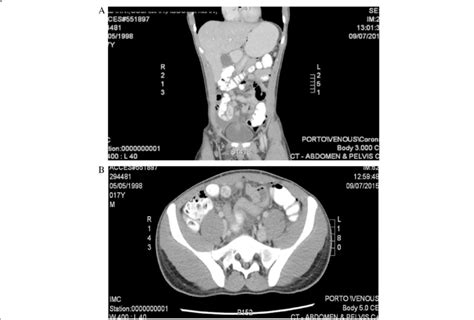 Ct Scan Of Abdomen And Pelvis Female