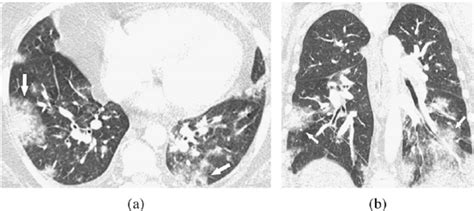 A Year Old Female With Daptomycin Induced Diffuse Alveolar Damage