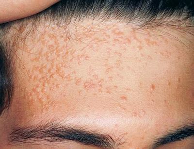 Flat Warts: Symptoms, Causes, and Ways of Treatment - Med Warts