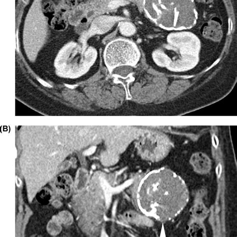 A 62 Year Old Woman With Complete Dorsal Pancreatic Agenesis With