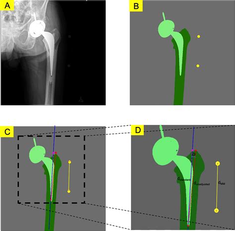 Deep Learning For Radiographic Measurement Of Femoral Component Subsidence Following Total Hip