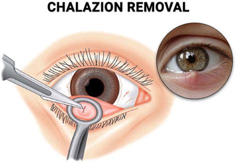 Full Article Chalazion Treatment A Concise Review Of Clinical Trials