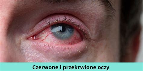 Czerwone i przekrwione oczy co mogą oznaczać te objawy