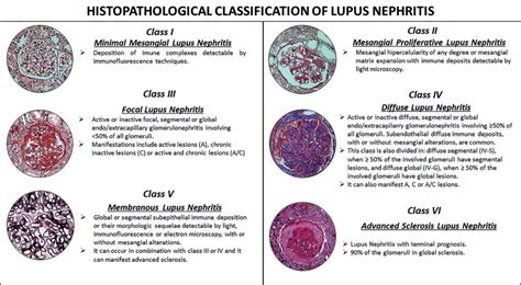 Pediatric lupus nephritis - Brazilian Journal of Nephrology (BJN)