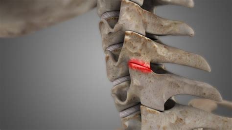 Cervical Facet Syndrome - ShimSpine