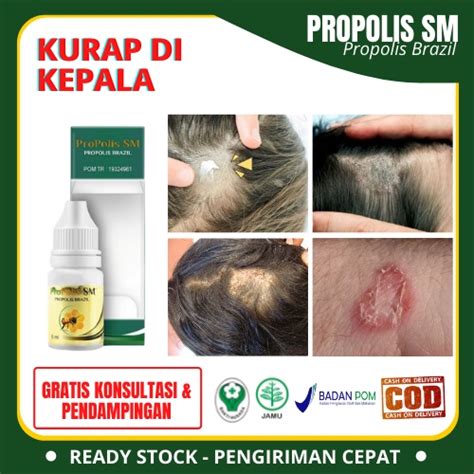 Jual Obat Kepala Pitak Salep Kulit Kepala Bersisik Obat Kurap Di