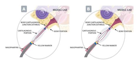 Eustachian Tube Dysfunction Specialty Care Institute