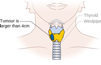 Medullary thyroid cancer staging - wikidoc