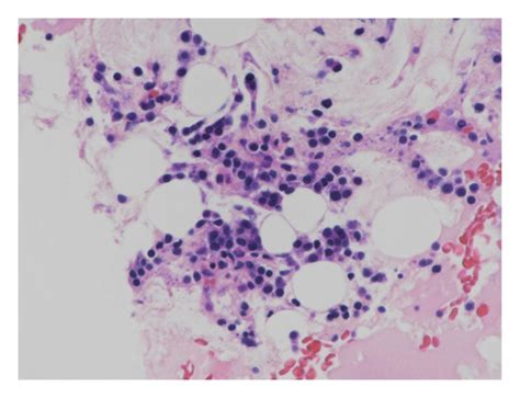 Pathological And Immunohistochemical Findings Of Bone Marrow Clot