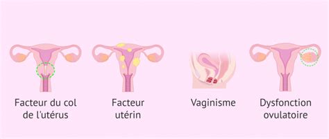 Indications De Liac Pour La Stérilité Féminine