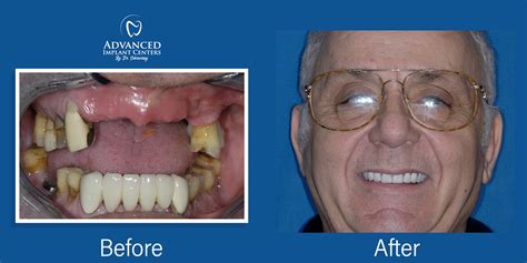 Dental Implants Marion In Louisville Ky