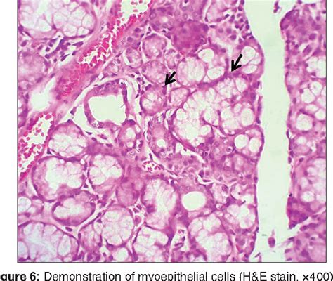 Figure 3 From Pathophysiology Of Myoepithelial Cells In Salivary Glands