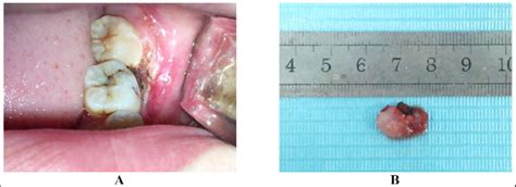 A Intraoperative View Of The Wound After Removal Of The Pregnancy