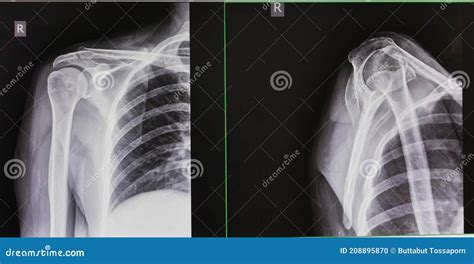 X射线图像肩ap和透视图 库存照片 图片 包括有 图象 视图 肩膀 208895870