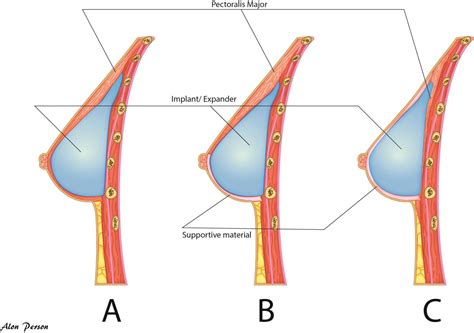 Estro Acrop Consensus Guideline For Target Volume Delineation In The