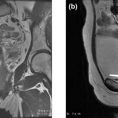 A And B T2 Weighted Coronal And Sagittal Magnetic Resonance Imaging