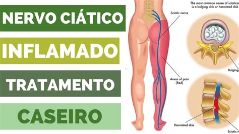 DOR no NERVO CIÁTICO Aprenda a tratar NERVO CIÁTICO INFLAMADO em Casa