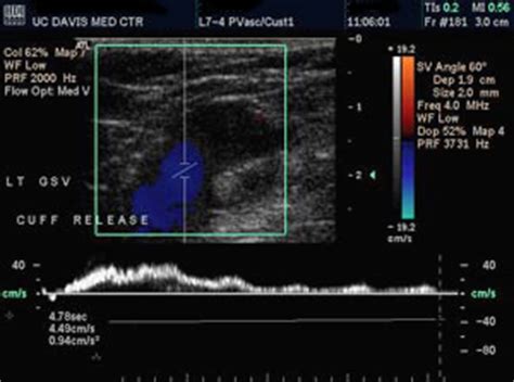 Venous Insufficiency | Vascular Center | UC Davis Health