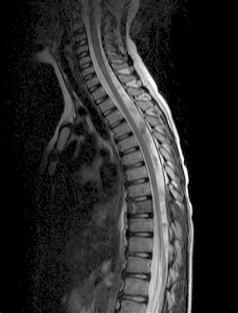 Typical Syrinx Like Manifestation Of Truncation Artifact In The Spinal