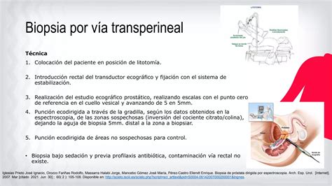 Biopsia de próstata transperineal BPT PPT