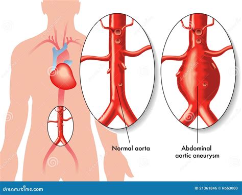 Abdominal Aortic Aneurysm Royalty Free Stock Image - Image: 21361846