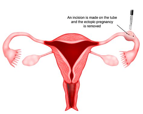 Laparotomy Ectopic Pregnancy