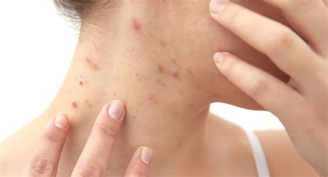 Neck Acne Causes Prevention Treatments You Should Know — Clarion Aesthetics